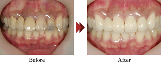 審美修復（オールセラミックス修復）