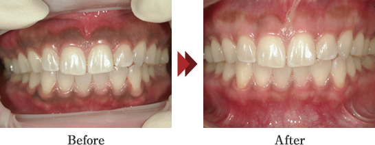 審美トリートメント（ガムピーリング）