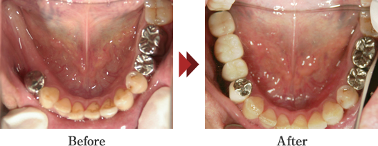 欠損修復（インプラント修復）