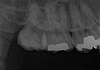 レントゲンでむし歯とかみ合わせのチェック
