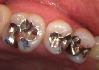 レントゲンでむし歯とかみ合わせのチェック