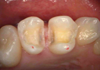 むし歯と除去と神経の保護