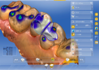 修復物のデザインと削り出し