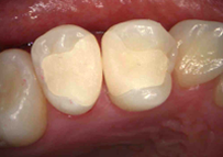 セラミックスを装着