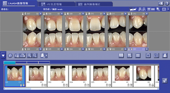 術前の歯の色調を測定し診断